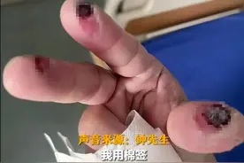 热闻|不小心碰了下，男子三根手指灼伤！流感高发，消毒别再这样做了！无效还伤身图片