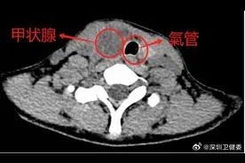 12岁女生甲状腺结节长成鸡蛋大小！医生：儿童的恶变率很高图片