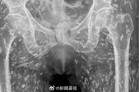 男子吃没熟猪肉下半身遍布绦虫卵，医生：见过最疯狂的X光片之一图片