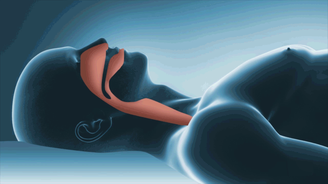 如何破解“十胖九鼾”图片