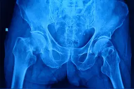 87岁老人髋部骨折卧床不起，多学科团队护航手术助他站起来图片