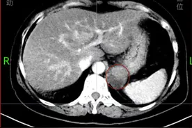不开刀切除胃部肿瘤，内镜下妙手“拆弹”图片