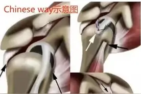 左肩扭伤致无法抬胳膊，原来是巨大肩袖撕裂图片