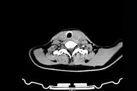 “亚毫米级”精准手术！花季少女嗓音“重生”记图片