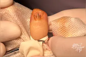 杭州女子频繁美甲，指甲上现“三叉戟”！医生紧急提醒图片