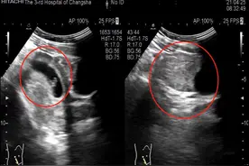 凶险！长沙孕妈发生早孕合并卵巢囊肿蒂扭转，妇产科专家紧急提醒图片