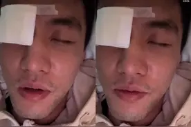 郭艾伦被队员手指插进眼珠，结膜破碎会失明吗？眼科医生：一般不会损伤视力图片