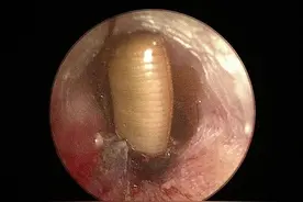 耳道内竟钻进蟑螂，正确处理方法来啦！图片