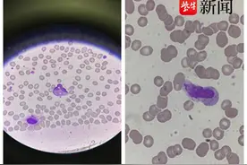 牙龈肿痛就是上火？白血病！看到验血报告，医生立即“摇人”救命图片