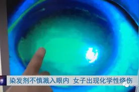 女子在家染头发，染发剂不小心溅入眼睛，下一秒……图片