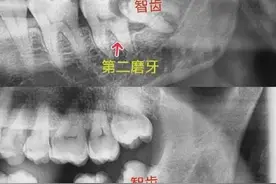 可怕！男子长智齿反复发炎致左脸烂出洞图片