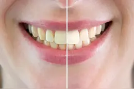 原来！健康的牙齿是这个颜色……图片