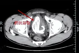 作孽啊！30厘米长玉制串珠塞进尿道拔不出来了，男子连声哀嚎：以后再也不敢了图片