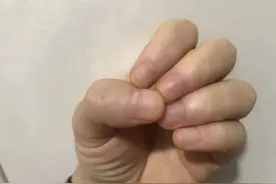 指甲没月牙、长竖纹、有凹陷、变黄……会有什么问题吗？图片