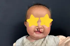 8月龄女婴严重唇腭裂影响进食，看华西专家如何妙手重塑“微笑”图片