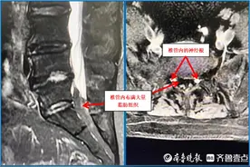 满意滕医丨腰腿酸痛下肢麻木，原来是脂肪在“作怪”图片