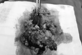 深圳一女子23年从未做过体检，一次就中招！胆囊里密密麻麻全是瘤图片