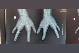 发病率十万分之一！4岁女孩天生“龙虾手”无法合拢 单只仅四根手指图片