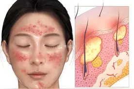 认识一下 青少年寻常痤疮图片