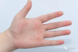 手上长透明小水泡，有点痒、脱皮……怎么回事？图片