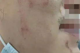 化脓糜烂差点毁容！皮肤科医生：近期多发，遇到这种“夜猫子”毒虫千万别拍打图片