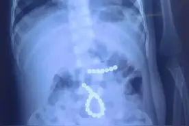 危险！孩子竟误吞27枚磁力珠……图片