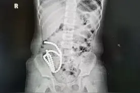 4岁女童误吞61粒磁力珠致肠穿孔 医生：先后误吞两颗以上磁力珠就可能导致肠穿孔图片