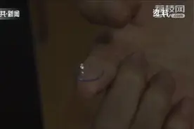 男子2个月不摘隐形眼镜，镜片与角膜竟然“合体”了！医生提醒→图片