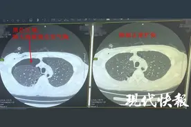 每天抽烟十几根，三十年老烟民“肺爆炸”了图片