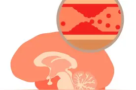 19岁就脑梗，步步都踩在“雷区”上！不注意这6点，小心脑梗找上门图片