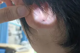 男孩踏青归来耳后多了一颗“黑痣”，医生提醒：千万别乱碰图片