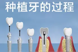 三分钟了解【种植牙】，“缺牙”的赶紧看看吧！图片