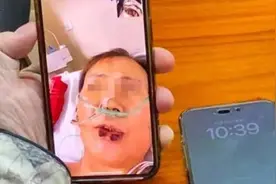 62岁上海阿姨为穿旗袍付出惨痛代价！6次手术花掉上百万，现依然躺在医院图片