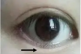 严重或致失明！南宁一3岁孩子从小怕光，竟是因为……图片