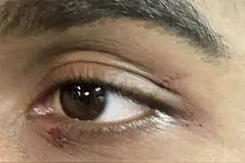 山东高速男篮外援克里斯眼睛受伤，赛后更衣室内第一时间简单处理图片