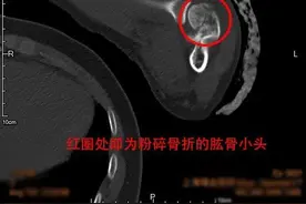 不慎骨折差点无法拿起手术刀？进修医生千里迢迢重回瑞金图片
