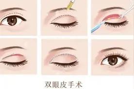 想割双眼皮，这些注意事项需了解丨健康智慧屋图片