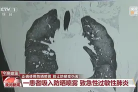 喷个防晒咋就肺炎了？正确使用喷雾 别让防晒变伤害图片
