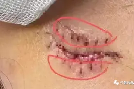 瓶子突然爆裂，缝了8针！这种网红饮品很多人在喝…图片