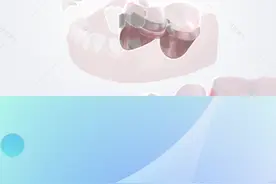 后牙缺失怎么修复呢？一起看看吧#健康dou起来 #医学科普 视频封面