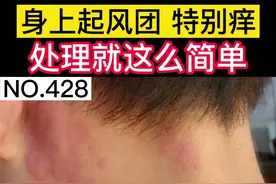 身上突然起很多红斑、风团，越挠越痒，教你这个方法，简单处理#荨麻疹 #皮肤 #科普 #健康 #痒 