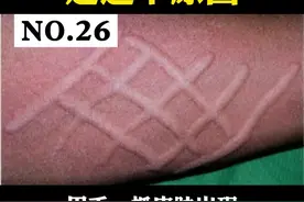 皮肤一抓就变红出现线条状的红色风团，可能是这个原因#人工荨麻疹 #人工性荨麻疹 视频封面