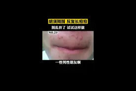 胡须周围老是长痘痘，一碰就疼，还日常影响刮胡子，我们别再乱挤了，试试这个办法#科普 #痘痘 #刮胡子 