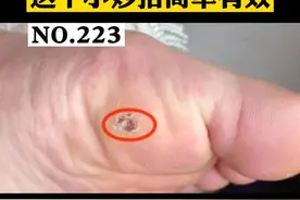 脚底长了一个小疙瘩，中间还有小黑点，这个是#跖疣 ，很多人以为是#鸡眼 ，这个小妙招简单处理，记得先点赞、收藏。#抖音小助手 视频封面